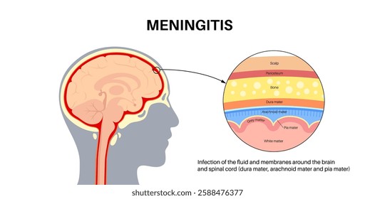 Meningitis inflammation of the protective layers surrounding the brain and spinal cord. Structure of meninges, headache diagnosis and treatment. Bacteria, viruses and fungi in the human head vector