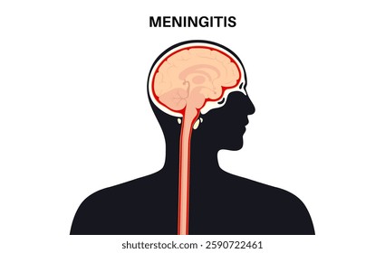 Meningitis inflammation of the protective layers surrounding the brain and spinal cord. Meninges disease medical poster. Bacteria, viruses, fungi, parasites in the human head flat vector illustration