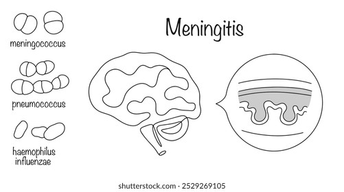 Meningite. Os principais agentes causadores da meningite e da manifestação da doença. Inflamação das membranas do cérebro e da medula espinhal. Vetor isolado. 