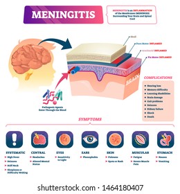 Meningitis vector illustration. Medical labeled brain covering membrane inflammation scheme. Educational anatomical diagram with isolated closeup side view structure, symptoms and complications list.