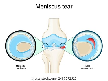 Desgarro meniscal. Anatomía de la rodilla. Primer plano de Menisco roto y daño del cartílago. Lesión deportiva de rodilla. Ilustración vectorial