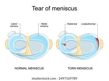 Meniscal tear. Torn meniscus. Knee injury. Cartilage damage. Meniscal repair. Sports injury. Head of tibia seen from above. Vector illustration