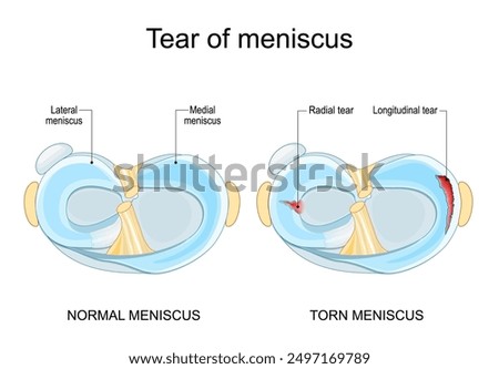 Meniscal tear. Torn meniscus. Knee injury. Cartilage damage. Meniscal repair. Sports injury. Head of tibia seen from above. Vector illustration