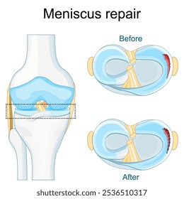 Meniskusverletzung. Nahaufnahme des Kniegelenks. Meniskalischer Riss vor und nach der Operation. Nahtreparatur. Meniskalische Heilung. Draufsicht auf ein menschliches Knie. Vektorposter