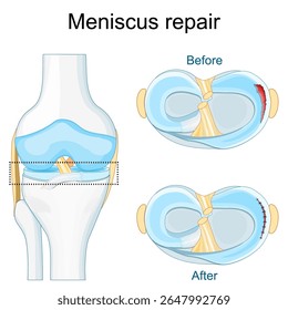 Lesão do menisco. Close da articulação do joelho. Laceração meniscal antes e depois da cirurgia. Reparo de sutura. Cicatrização meniscal. Vista de cima de um joelho humano. Cartaz vetorial