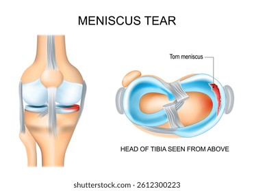 Meniscus tear. Knee anatomy. Close-up of Torn meniscus and cartilage damage. Sports knee injury. Head of tibia seen from above. Vector illustration. Medical poster. Schematic diagram. 
