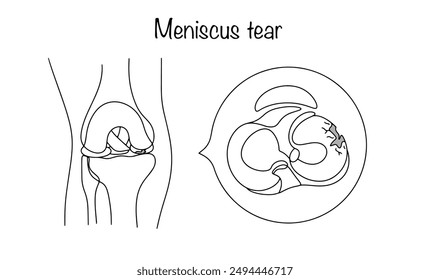 Meniscus tear. Mechanical damage to the cartilage tissue located between the tibia and femur. Vector illustration.