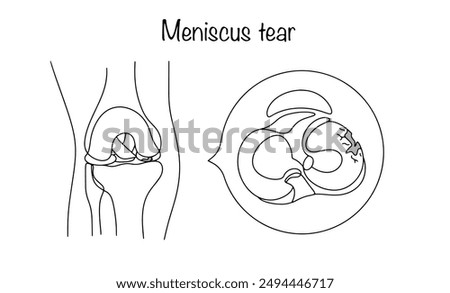Meniscus tear. Mechanical damage to the cartilage tissue located between the tibia and femur. Vector illustration.