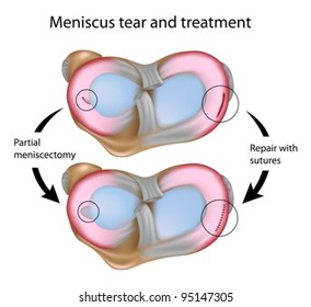 Meniscus Tear And Surgery