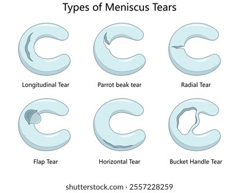 meniscus tears, including longitudinal, radial, parrot beak, flap, horizontal, and bucket handle tears diagram hand drawn schematic vector illustration. Medical science educational illustration