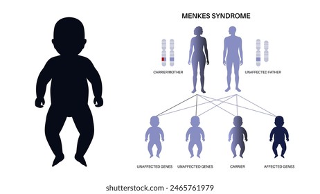 Menkes syndrome, genetic slow development disease pattern. Joint bones and internal organs problem. Child inherits one copy of a mutated gene from each parent. Affected, carriers or healthy chromosome