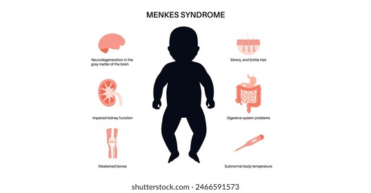 Menkes syndrome, genetic slow development disease poster. Joint bones and internal organs problem. Child inherits one copy of a mutated gene from each parent. Affected, carriers or healthy chromosome