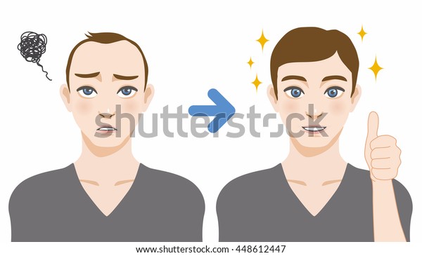 Mens Thinning Hair Treatment Before After Royalty Free Stock Image