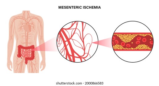 Isquemia mesentérica, colesterol en los vasos sanguíneos humanos. Colitis en el intestino. Células grasas en la arteria venosa. Vascular bloqueada en colon, concepto de embolismo. Afiche médico para la ilustración clínica de vector plano