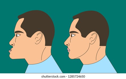 Mesial bite, man with malocclusion, lower jaw extended forward, bite correction by braces. Vector illustration