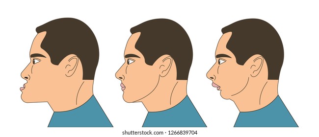 Mesial and distral bite, man with malocclusion, lower jaw extended forward, lower jaw pushed back, bite correction by braces. Vector illustration