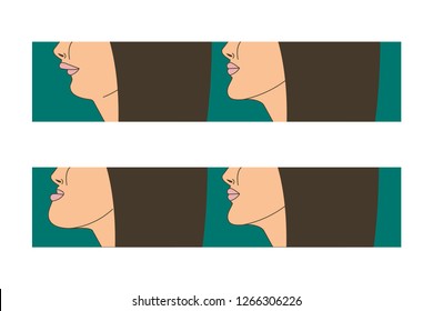 Mesial and distral bite, woman with malocclusion, lower jaw extended forward, bite correction by braces. Vector illustration