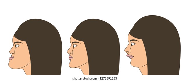 Mesial and distral bite, woman with malocclusion, lower jaw extended forward, lower jaw pushed back, bite correction by braces. Vector illustration