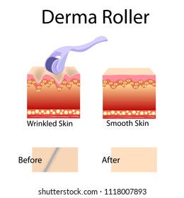 Mesorolling process and cell structure, before after effect