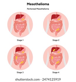 Mesothelioma disease, Pericardial mesothelioma, 4 stages
