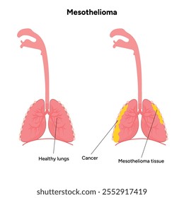 Mesothelioma lungs pulmonalsystem krankheit, lungenprobleme