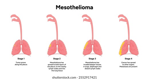 Mesothelioma lungs pulmonalsystem krankheit, lungenprobleme