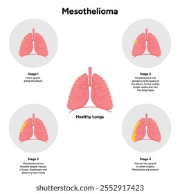 Mesothelioma lungs pulmonalsystem krankheit, lungenprobleme