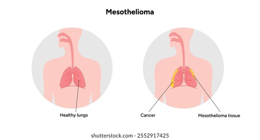 Mesothelioma lungs pulmonalsystem krankheit, lungenprobleme