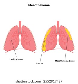 Mesothelioma lungs pulmonalsystem krankheit, lungenprobleme