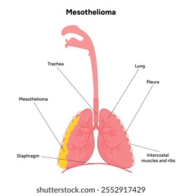 Mesothelioma lungs pulmonalsystem krankheit, lungenprobleme