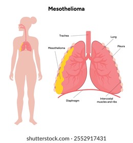 Mesothelioma lungs pulmonalsystem krankheit, lungenprobleme