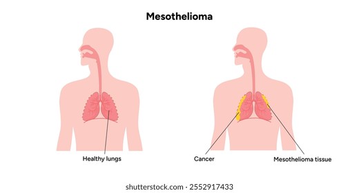 Mesothelioma lungs pulmonalsystem krankheit, lungenprobleme