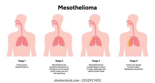 Mesothelioma lungs pulmonalsystem krankheit, lungenprobleme