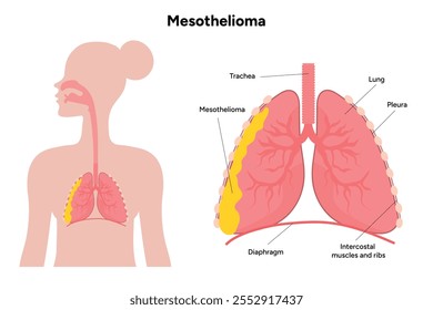 Mesothelioma lungs pulmonalsystem krankheit, lungenprobleme