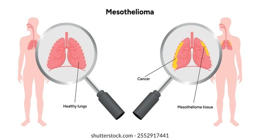 Mesothelioma lungs pulmonalsystem krankheit, lungenprobleme