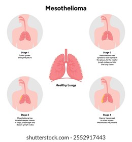 Mesothelioma lungs pulmonalsystem krankheit, lungenprobleme