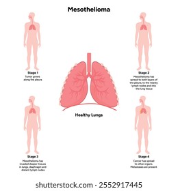 Mesothelioma lungs pulmonalsystem krankheit, lungenprobleme