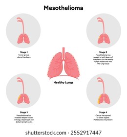 Mesothelioma lungs pulmonalsystem krankheit, lungenprobleme