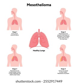 Mesothelioma lungs pulmonalsystem krankheit, lungenprobleme