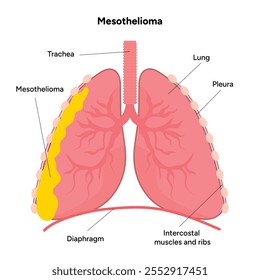 Mesothelioma lungs pulmonalsystem krankheit, lungenprobleme