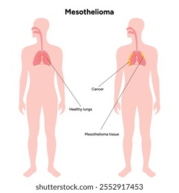 Mesothelioma lungs pulmonalsystem krankheit, lungenprobleme