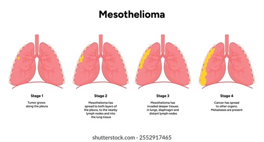 Mesothelioma lungs pulmonalsystem krankheit, lungenprobleme