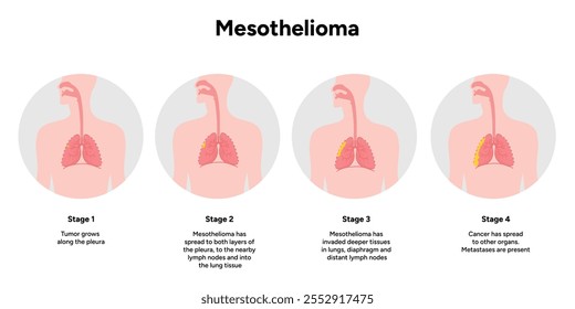 Mesothelioma lungs pulmonalsystem krankheit, lungenprobleme