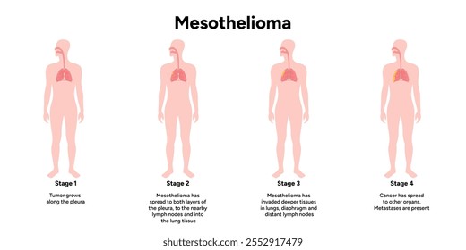 Mesothelioma lungs pulmonalsystem krankheit, lungenprobleme