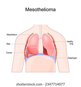 mesothelioma. Malignant tumor of lung after Asbestos exposure. Vector illustration