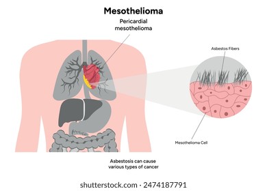 Mesothelioma, Pericardial mesothelioma, asbestos fibers 