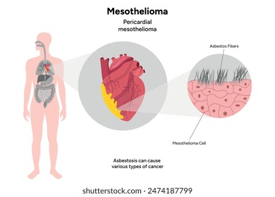 Mesothelioma, Pericardial mesothelioma, asbestos fibers