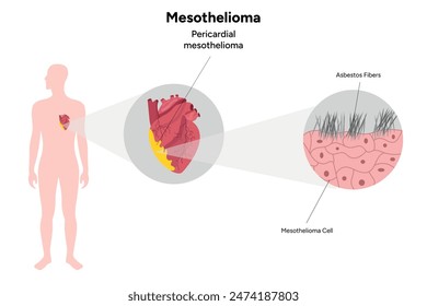 Mesothelioma, Pericardial mesothelioma human and heart zoom