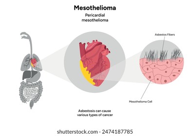 Mesothelioma, Pericardial mesothelioma, internal organs, zoom heart, asbestos fibers
