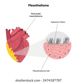 Mesothelioma, Pericardial mesothelioma zoom heart